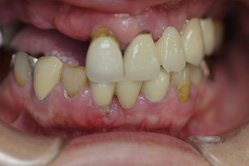 上顎チタン床義歯　下顎メタルボンド　＋　部分床義歯