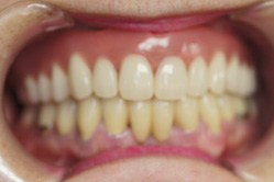 上顎チタン床義歯　下顎メタルボンド　＋　部分床義歯