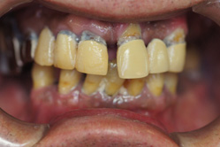 上顎チタン床義歯　下顎ハイブリッドクラウン　＋　ミリングインターロック義歯