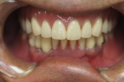 上顎チタン床義歯　下顎ハイブリッドクラウン　＋　ミリングインターロック義歯