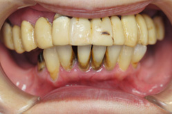 上顎チタン床義歯　下顎MTM　＋メタルボンド　＋　部分床義歯