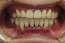 上顎チタン床義歯　下顎MTM　＋メタルボンド　＋　部分床義歯