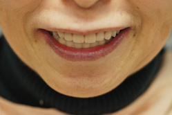 上顎チタン床義歯　下顎MTM　＋メタルボンド　＋　部分床義歯