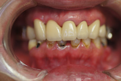 咬合治療　＋　下顎メタルボンド　ミリングインターロック義歯