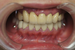 咬合治療　＋　下顎メタルボンド　ミリングインターロック義歯