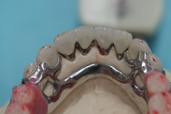 咬合治療　＋　下顎メタルボンド　ミリングインターロック義歯