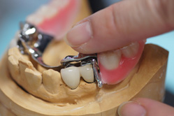 下顎メタルボンド　＋　BAI義歯