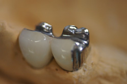 下顎メタルボンド　＋　BAI義歯