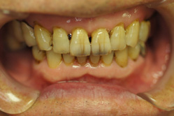 下顎メタルボンド　＋　アタッチメントデンチャー