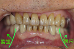 下顎メタルボンド　＋　アタッチメントデンチャー