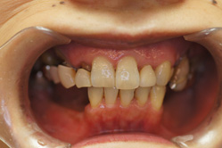 咬合治療　＋　上顎コーヌスクローネ　下顎ミリング　インターロック義歯