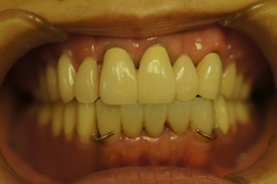 咬合治療　＋　上顎コーヌスクローネ　下顎ミリング　インターロック義歯