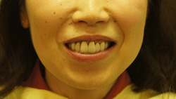 咬合治療　＋　上顎コーヌスクローネ　下顎ミリング　インターロック義歯