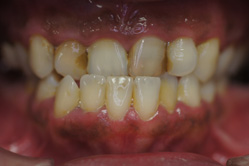 咬合治療＋セラミックレイヤリング ジルコニアクラウン