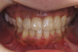 咬合治療＋セラミックレイヤリング ジルコニアクラウン