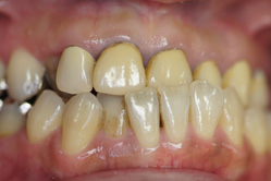 咬合治療＋セラミックレイヤリング ジルコニアクラウン