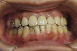 咬合治療＋セラミックレイヤリング ジルコニアクラウン