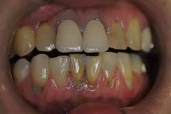 上下顎ホワイトニング　＋　メタルボンド　＋　下顎部分床義歯