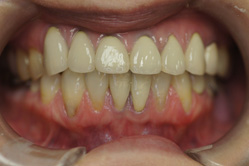 上下顎ホワイトニング　＋　メタルボンド　＋　下顎部分床義歯