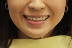 上下顎ホワイトニング　＋　メタルボンド　＋　下顎部分床義歯