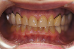 咬合治療　＋　上顎前歯グラディアダイレクト　上下顎メタルボンド　下顎部分床義歯
