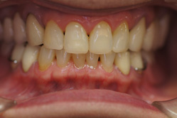 咬合治療　＋　上顎前歯グラディアダイレクト　上下顎メタルボンド　下顎部分床義歯