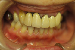 咬合治療　上下顎セラミックレイヤリング ジルコニアクラウン　＋　単体ジルコニアクラウン