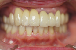 咬合治療　上下顎セラミックレイヤリング ジルコニアクラウン　＋　単体ジルコニアクラウン