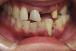 下顎MTM（小さな矯正）　＋　上下顎ハイブリッドクラウン