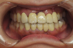 下顎MTM（小さな矯正）　＋　上下顎ハイブリッドクラウン