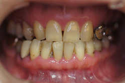 咬合治療　＋　上下顎ホワイトニング　＋　ハイブリッドクラウン　＋　グラディアダイレクト