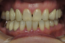 咬合治療　＋　上下顎ホワイトニング　＋　ハイブリッドクラウン　＋　グラディアダイレクト