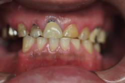 咬合治療　＋　歯周外科　＋　部分床義歯