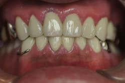 咬合治療　＋　歯周外科　＋　部分床義歯