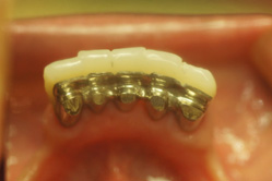 ミリング、インターロック加工