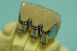 ミリング、インターロック加工