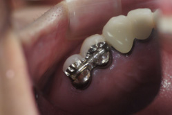 咬合面レスト　＋　インターロック