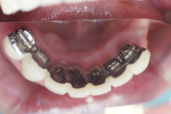 咬合面レスト　＋　インターロック