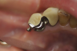 アタッチメント