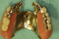 メタルティース