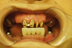 コーヌスクローネ