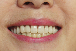 上顎チタン床義歯　下顎メタルボンド　＋　部分床義歯