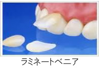 ラミネートベニア