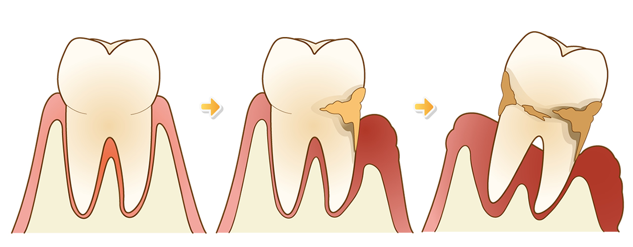 歯周病治療
