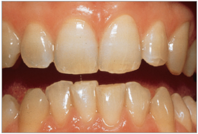 ホワイトニング