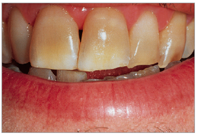 ホワイトニング