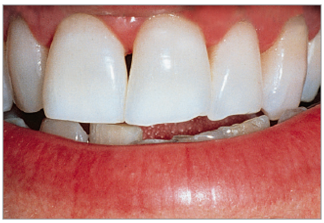 ホワイトニング