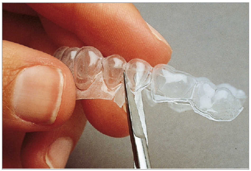 ホワイトニング