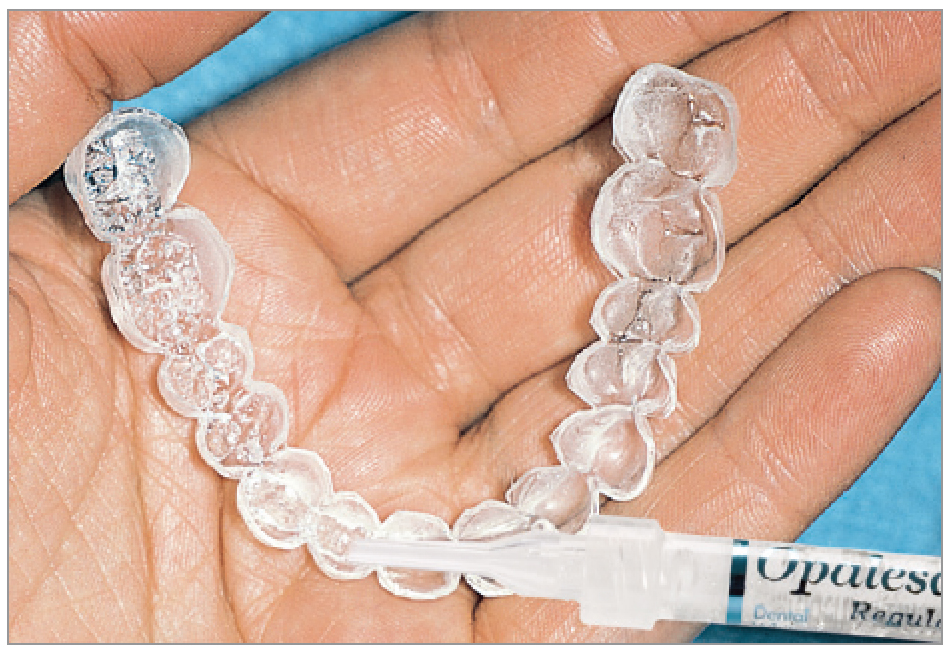 ホワイトニング