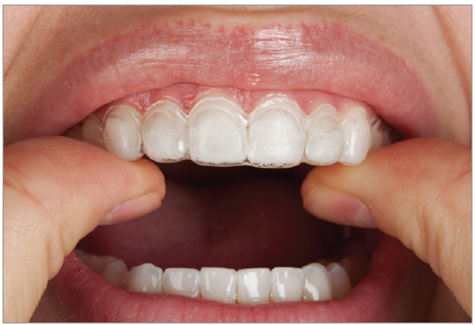 ホワイトニング